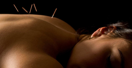 Acupuncture